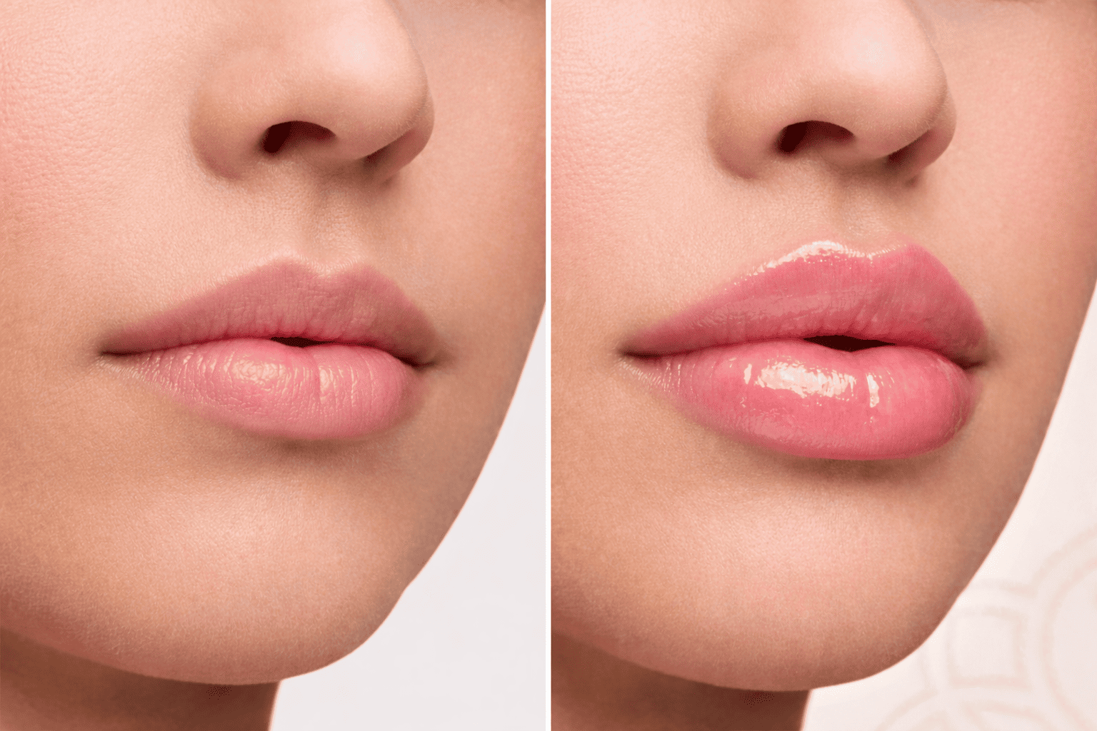 Aplicación de lip fillers